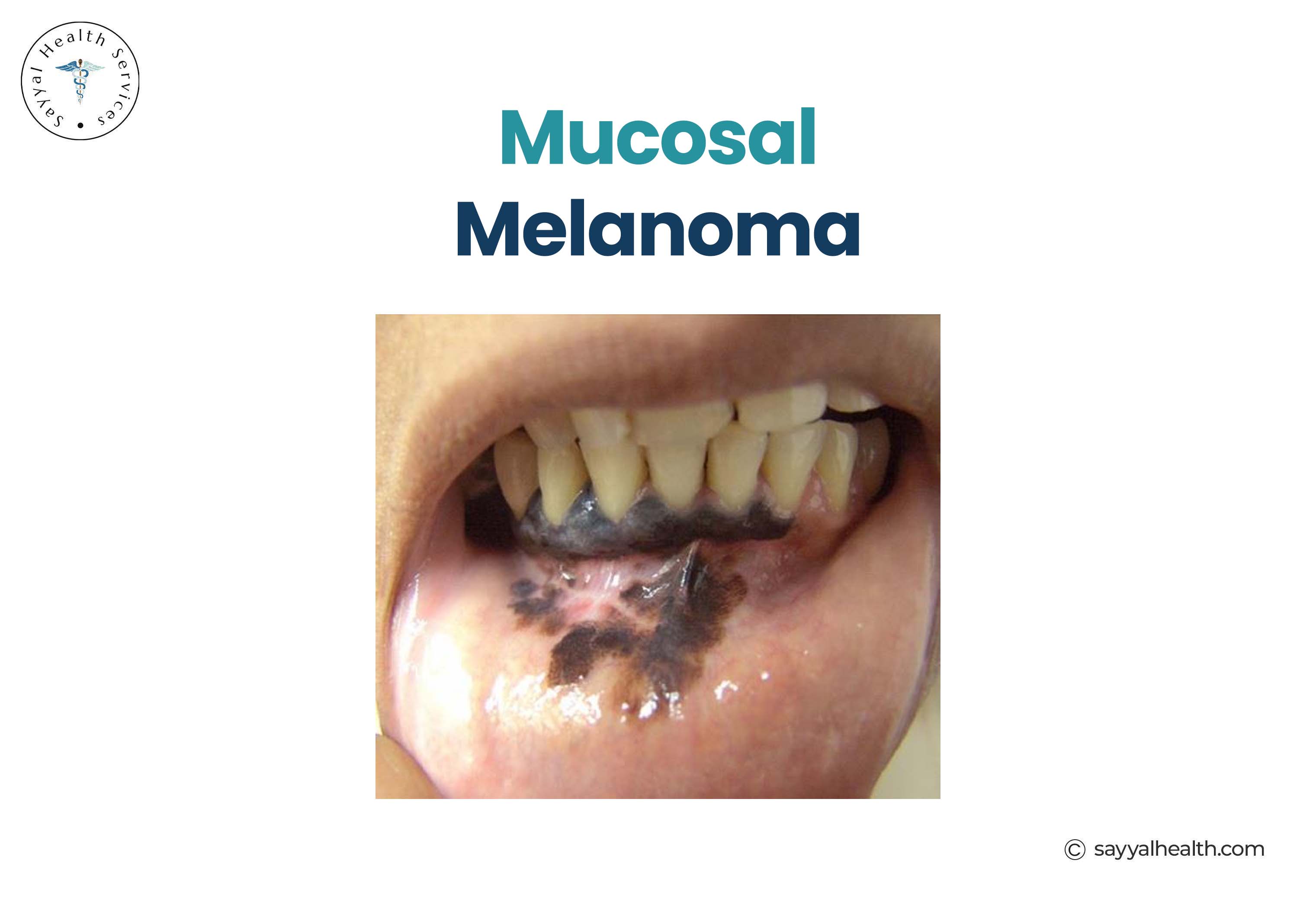 Photo of Mucosal Melanoma